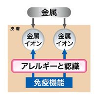 金属アレルギーのしくみ