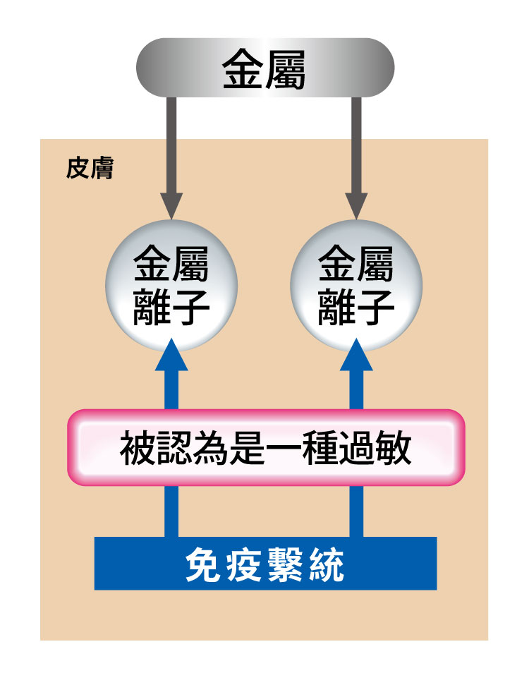 關於金屬過敏